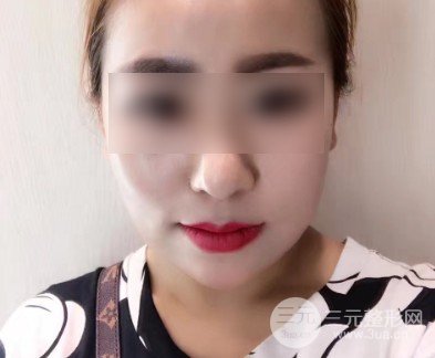 打注射瘦脸几天有果