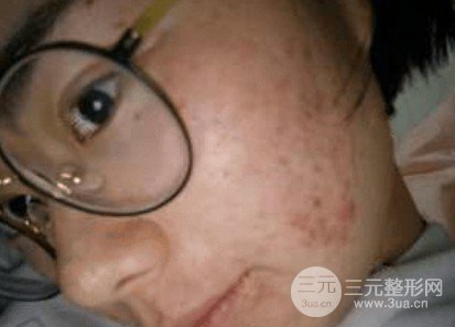 怎么缓解痘疤