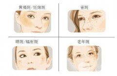 面部黄褐斑怎么缓解?这篇文章分析很详细