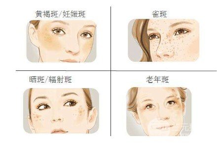 面部黄褐斑怎么缓解