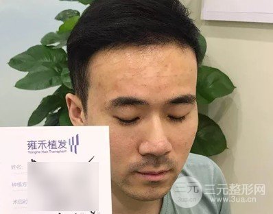 头发少怎么植发