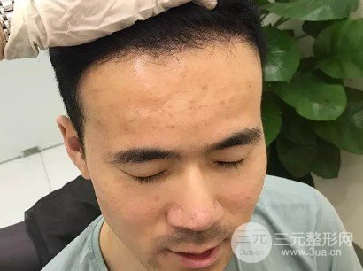 头发少怎么植发