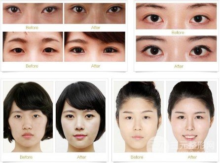 开眼角手术风险大吗