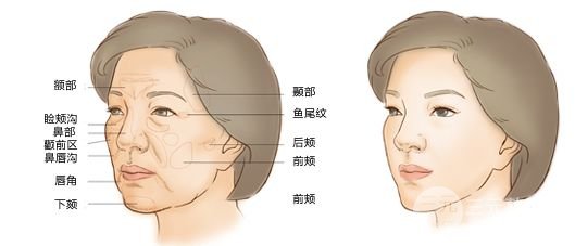 自体脂肪填充的价格