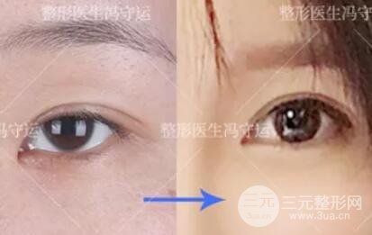 开眼角和不开的区别图