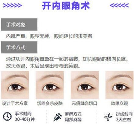 开眼角整形术用哪一个方式好