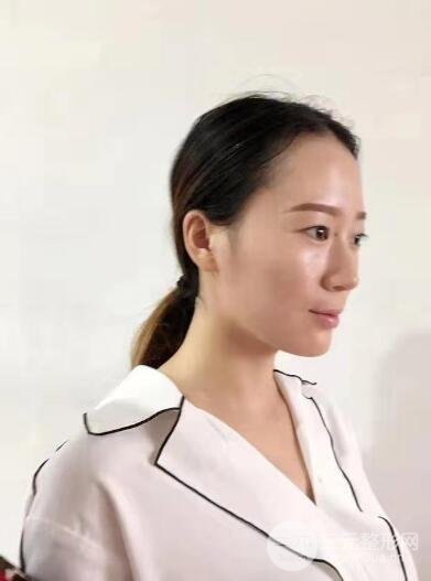 上海九院顾斌双眼皮风格怎么样?顾斌医生技术测评&双眼皮案例