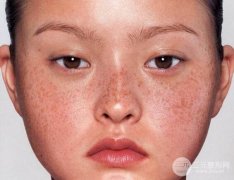 光子祛斑10天变化图片来啦，光子祛斑副作用有吗？