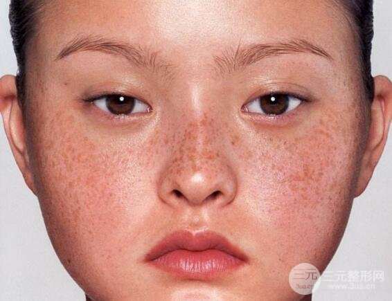 光子祛斑10天变化图片来啦，光子祛斑副作用有吗？