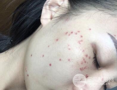 光子祛斑一周后