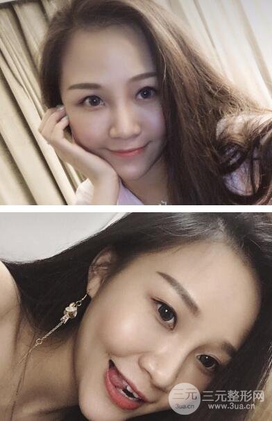 光子祛斑一周后