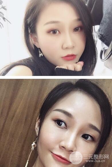 光子祛斑十天后