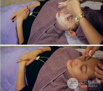 光子祛斑有副作用吗?