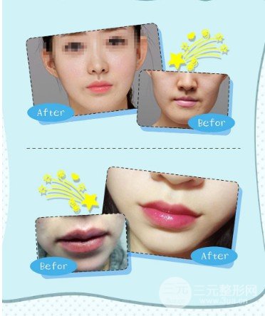 自体脂肪丰唇恢复期