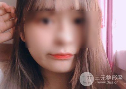 自体脂肪丰唇恢复期