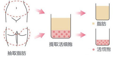 脂肪填充法令纹好吗?1针饱满1周消肿~