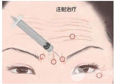 额头自体脂肪填充多少钱