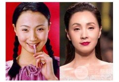 眼窝填充脂肪减少吸收率,千万别做冷热敷! 眼窝填充脂肪减少吸收率,千万别做冷热敷!