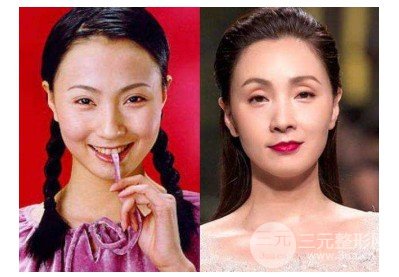 眼窝填充脂肪减少吸收率
