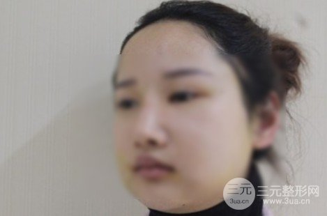 下颌骨整形价钱多少