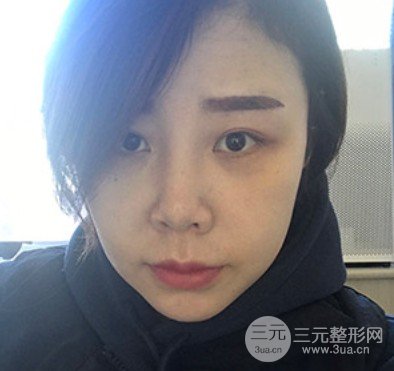 注射溶脂多少钱一针