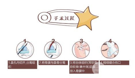 肋软骨隆鼻会吸收吗