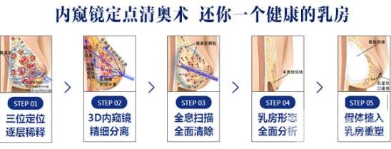 奥美定取出