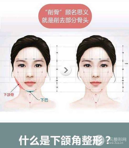 国字脸削骨价格一般多少钱？手术注意事项以及案例图分享~