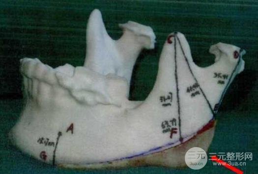 国字脸削骨价格一般多少钱？手术注意事项以及案例图分享~