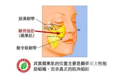 颧骨高怎么办