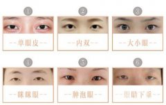 内双可以割双眼皮吗?会不会变成三眼皮?
