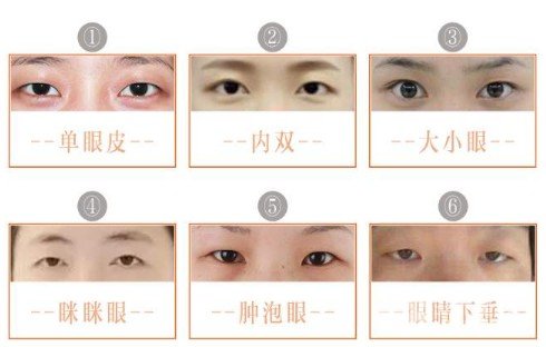 内双可以割双眼皮吗