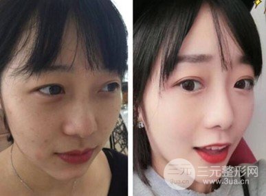 内双可以割双眼皮吗