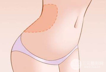 腹部吸脂的费用多少