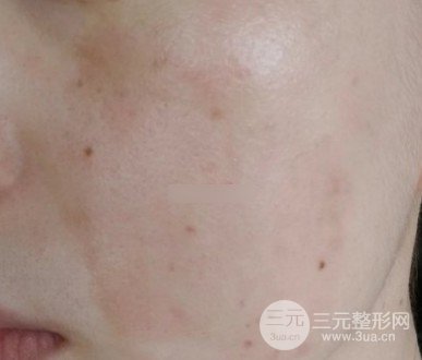 激光祛斑一次多少钱