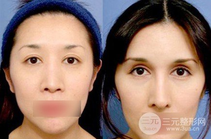 欧式双眼皮适合人群