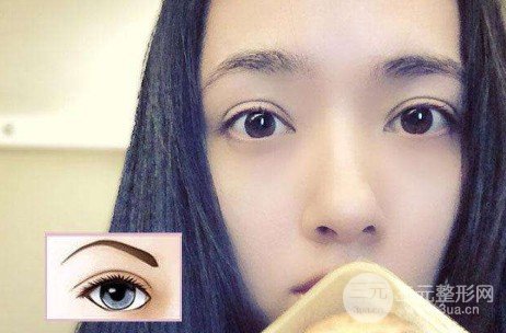 欧式双眼皮适合人群