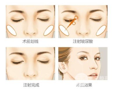 颧骨高怎么办