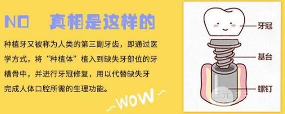 种植牙的时间