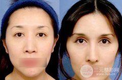 做双眼皮开眼角新手注意事项，手术果多图