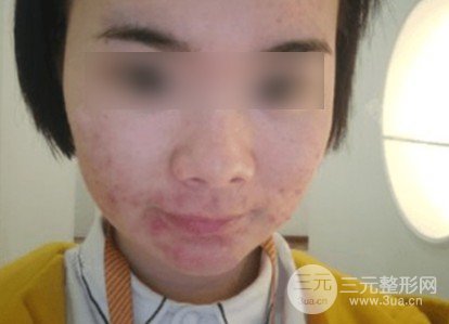 果酸焕肤前后果对比图