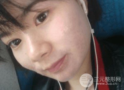 果酸焕肤前后果对比图