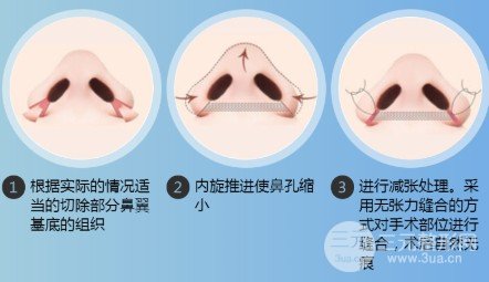 鼻头鼻翼缩小手术风险