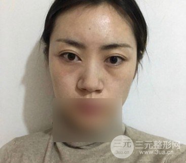 鼻尖整形对比图