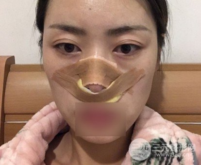 鼻尖整形对比图