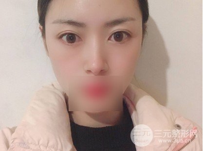 鼻尖整形对比图