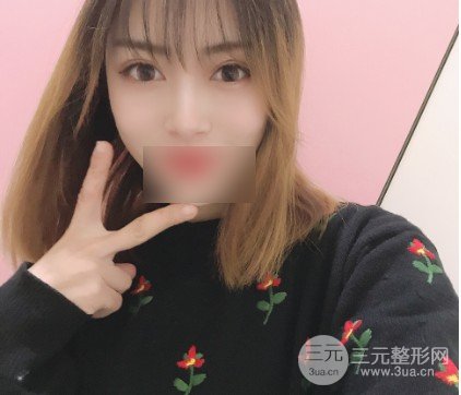 鼻尖整形对比图