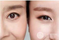 上眼皮松弛怎么改良?正规医院有哪几种手术? 上眼皮松弛怎么改良?正规医院有哪几种手术?