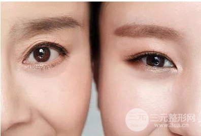 上眼皮松弛怎么改良