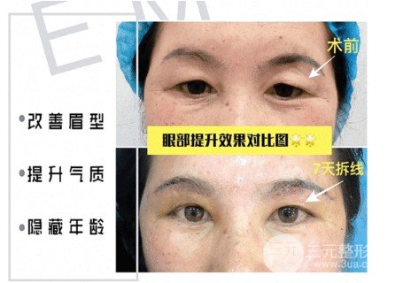 上眼皮松弛怎么改良